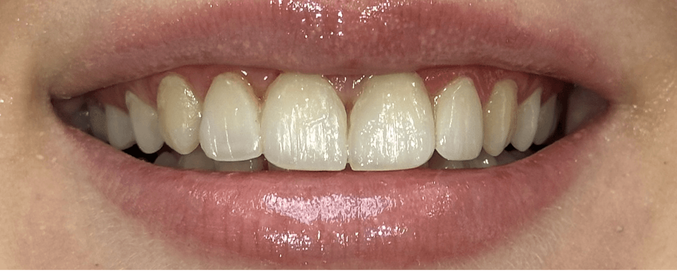 Ortodontik Diastema Kapatma