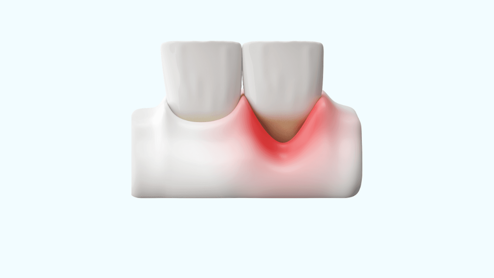 Diş Eti Çekilmesi (Gingival Resesyon) Nedir?