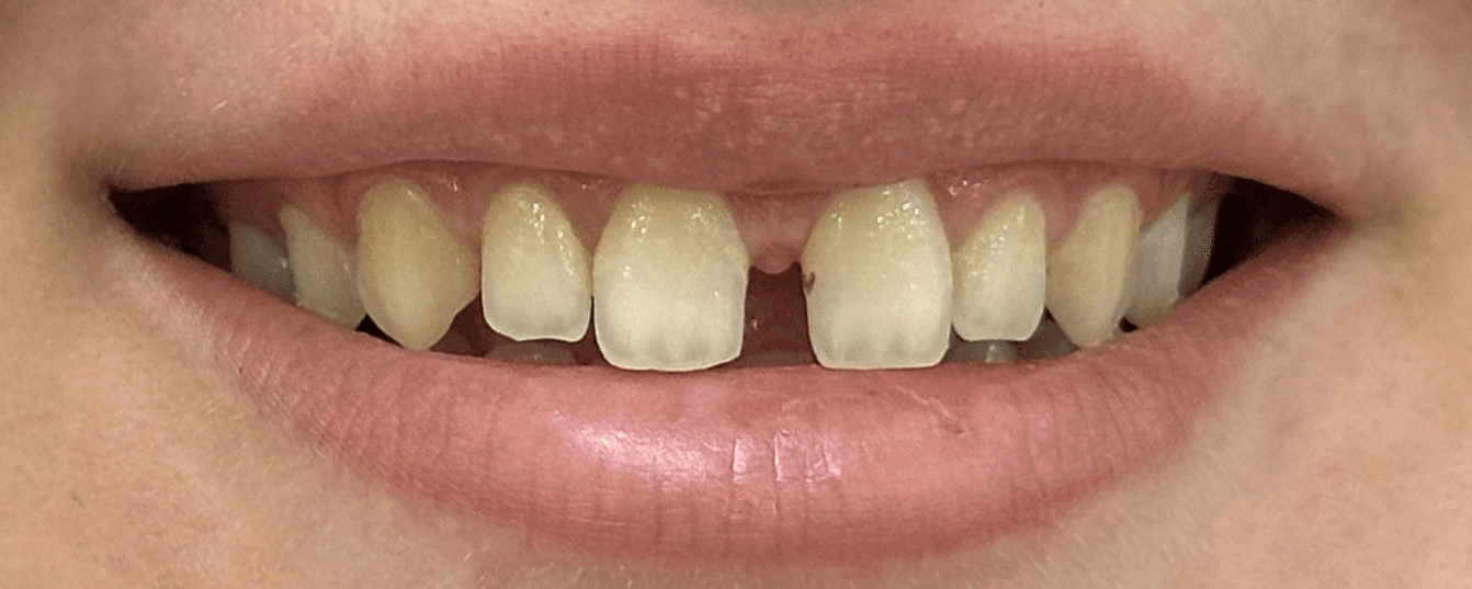 Ortodontik Diastema Kapatma - öncesi